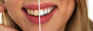 Teeth whitening before and after image