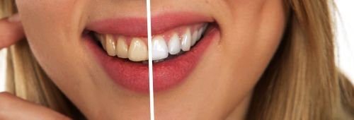 teeth whitening - dental services - Brandon Street Dentists
