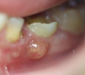 Gum abscess