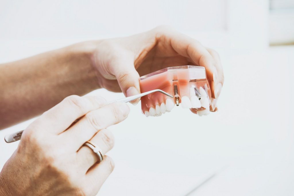 dental implants - Brandon Street Dentists