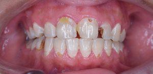 Dental decay